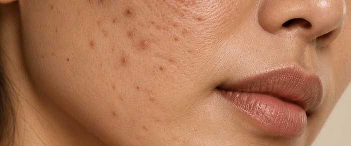 Active acne and post-acne marks on the cheek