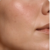 Close-up of skin during a treatment
